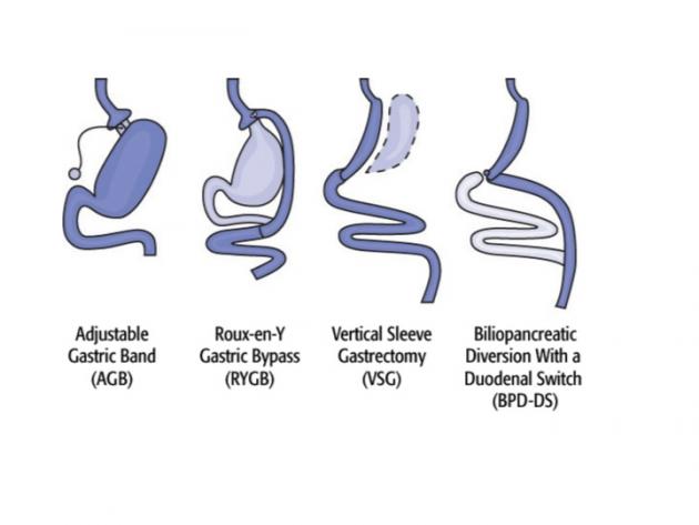 Surgical Procedures