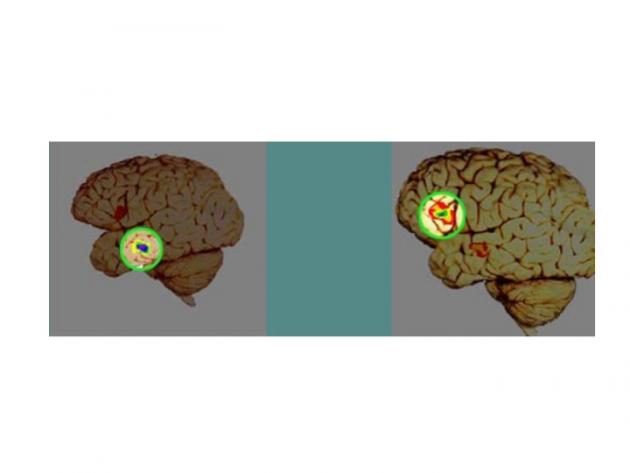 Differences in Adolescent and Adult Brain