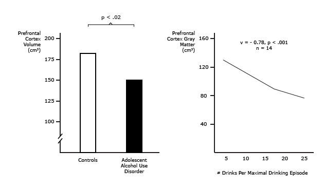 Adolescent Onset Alcohol Use Disorder is Associated with Smaller Prefrontal Cort